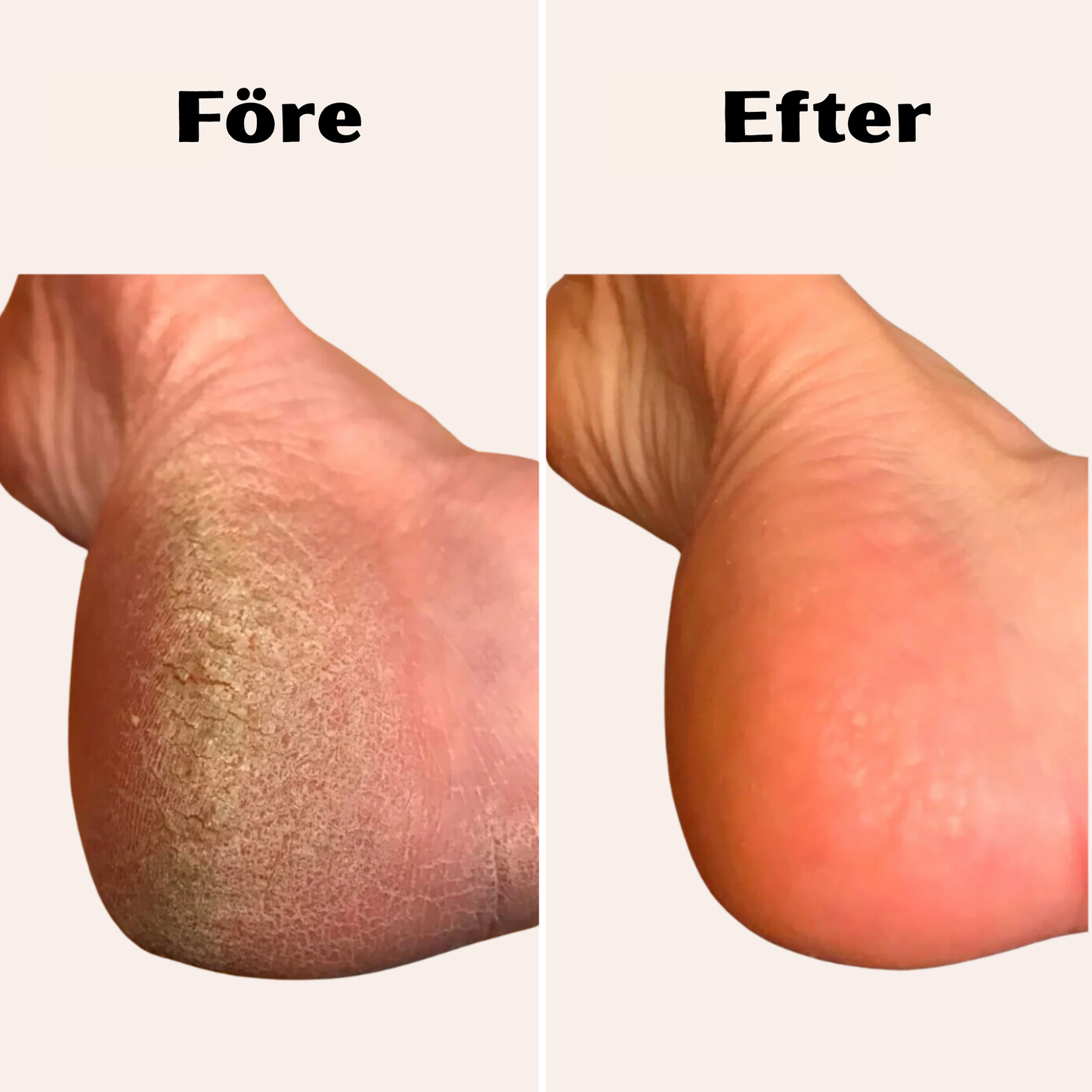 FlexoraCare I Elektrisk Fotfil för Hård Hud med Vattentät Design I Effektiv Behandling för Mjuka Fötter