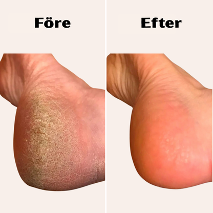 FlexoraCare I Elektrisk Fotfil för Hård Hud med Vattentät Design I Effektiv Behandling för Mjuka Fötter